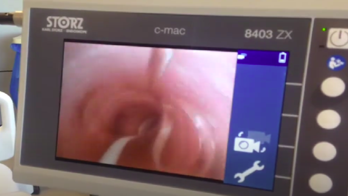 Rapid Bronchoscopy for ETT Confirmation